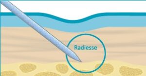 Radiesse(Calcium Hydroxylapatite): наукове обґрунтування волюмізації, біостимуляції та ремоделювання тканин у сучасній естетичній медицині