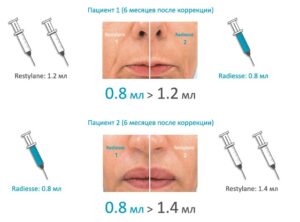 Radiesse(Calcium Hydroxylapatite): наукове обґрунтування волюмізації, біостимуляції та ремоделювання тканин у сучасній естетичній медицині