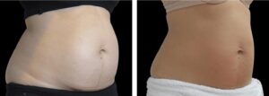 До/після RF-ліфтингу BTL Exilis у "Медестет" Вінниця